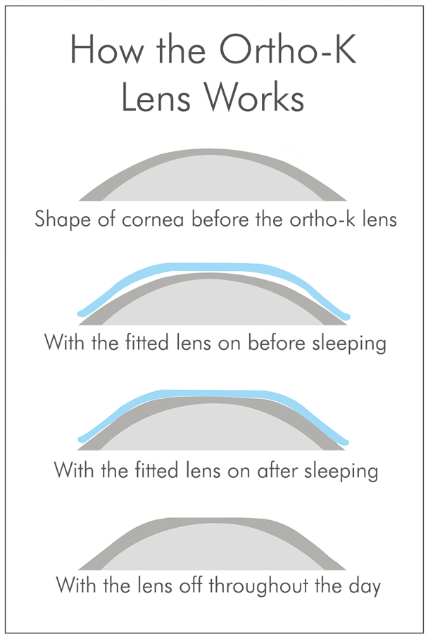 How OrthoK Works iSee Orthokeratology Contact Lenses